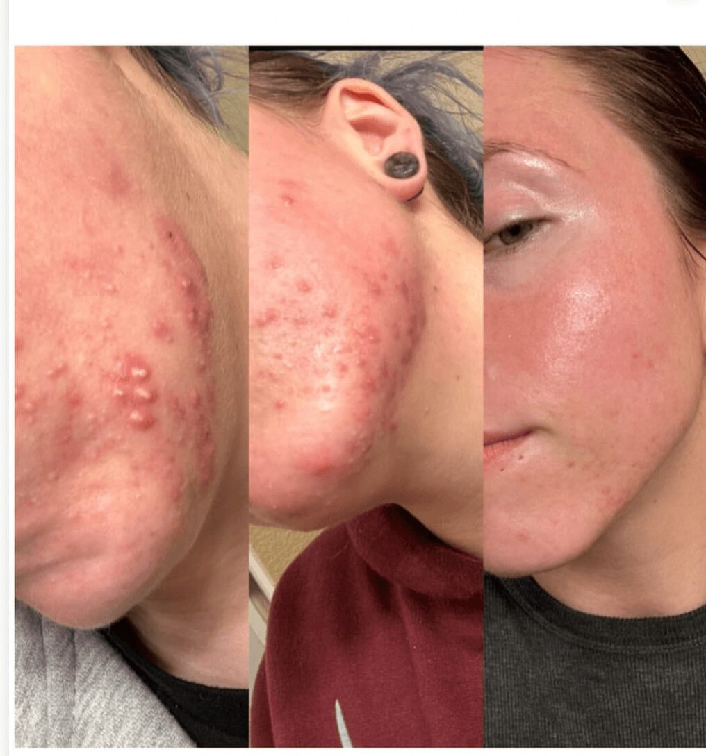 Close-up of three different skin conditions on faces, showing acne and clear skin, with visible pores and redness.
