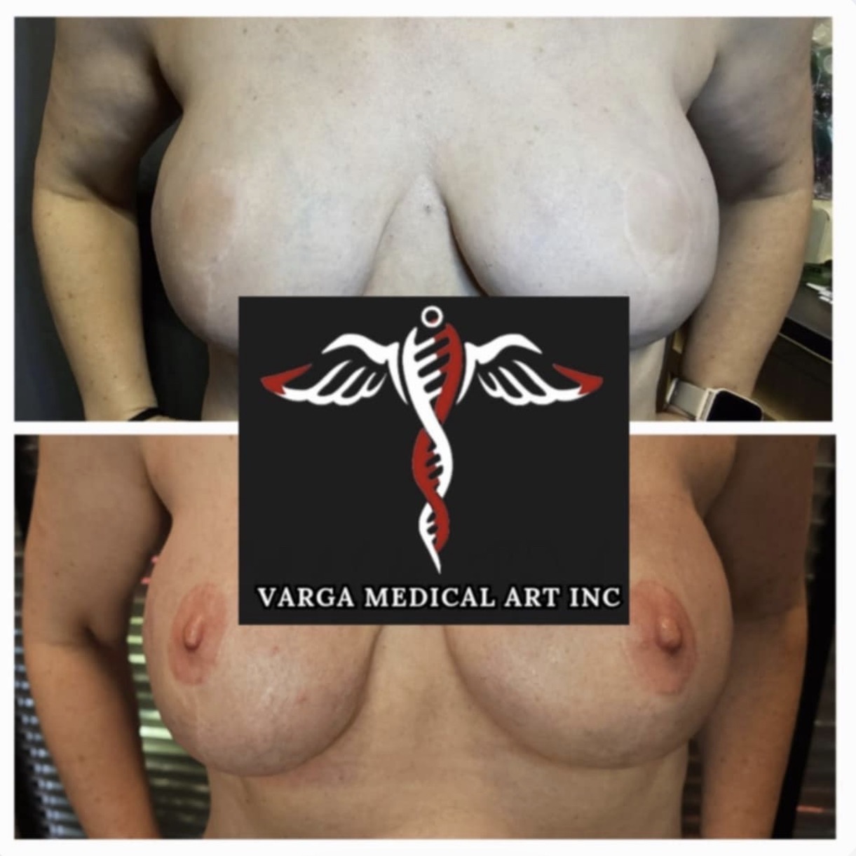 Comparison of two images showing a person's chest before and after medical treatment, with a medical logo overlay in the center.