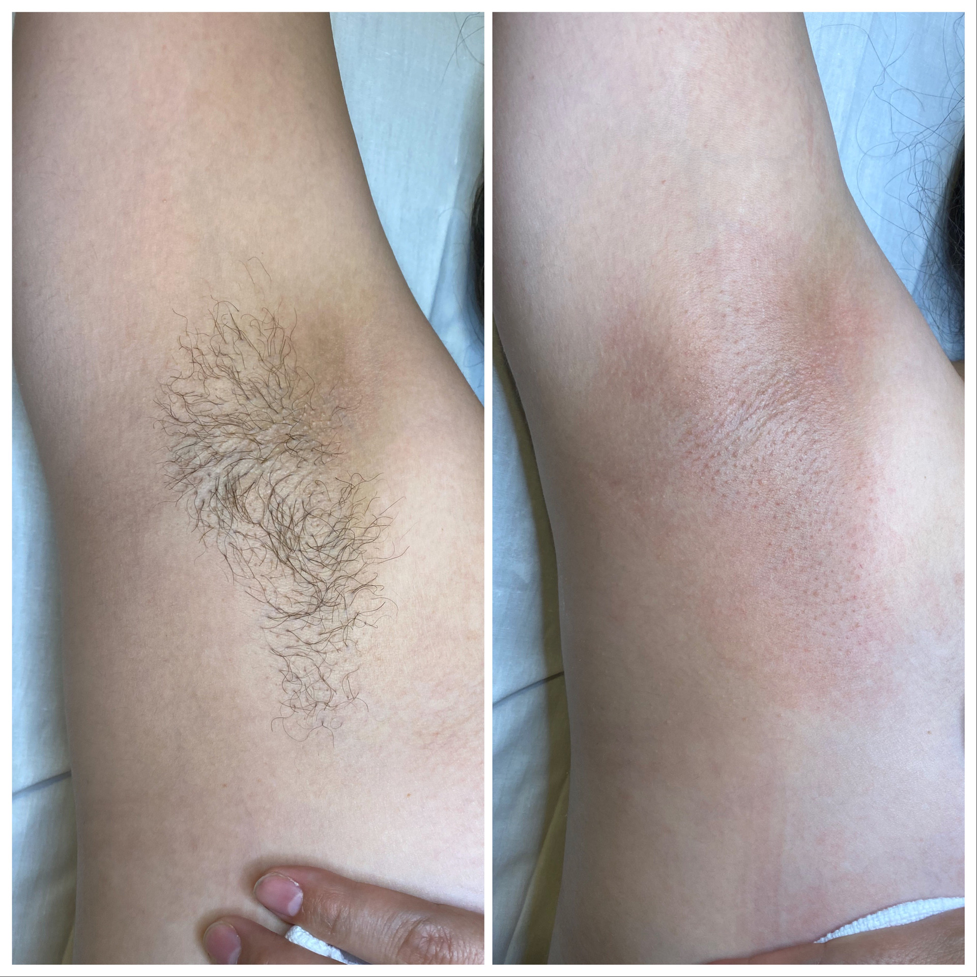 Comparison of armpit before and after hair removal, showing reduced hair and smoother skin.