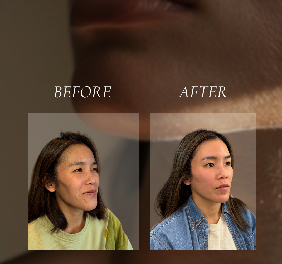 Comparison of a woman's face before and after a procedure, showing changes in skin appearance and facial features.