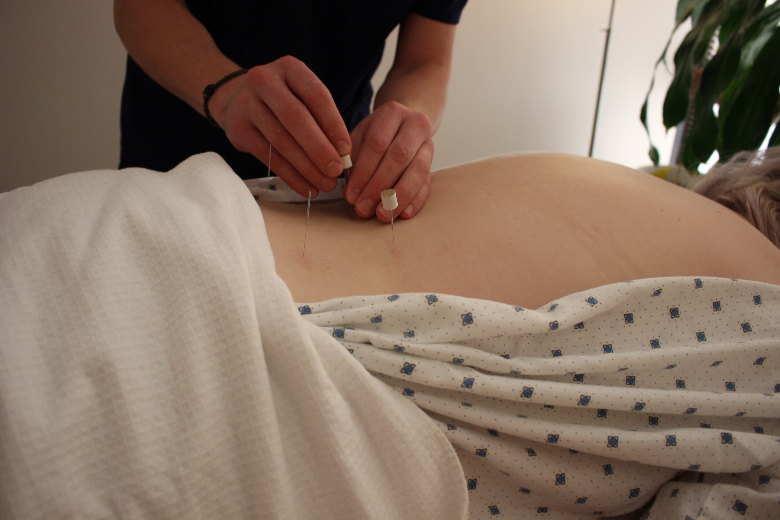 Person receiving acupuncture treatment on back, with practitioner inserting needle, in a clinical setting with a plant in the background.