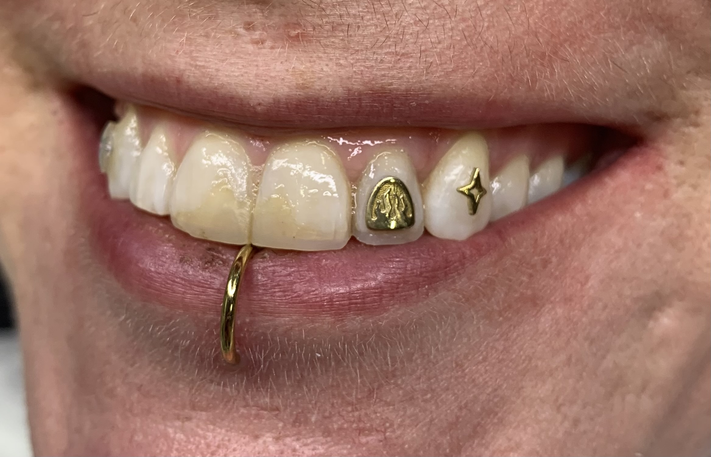 Close-up of a person's mouth with gold dental caps, a gold tooth, and a gold lip ring, showing teeth and lips.