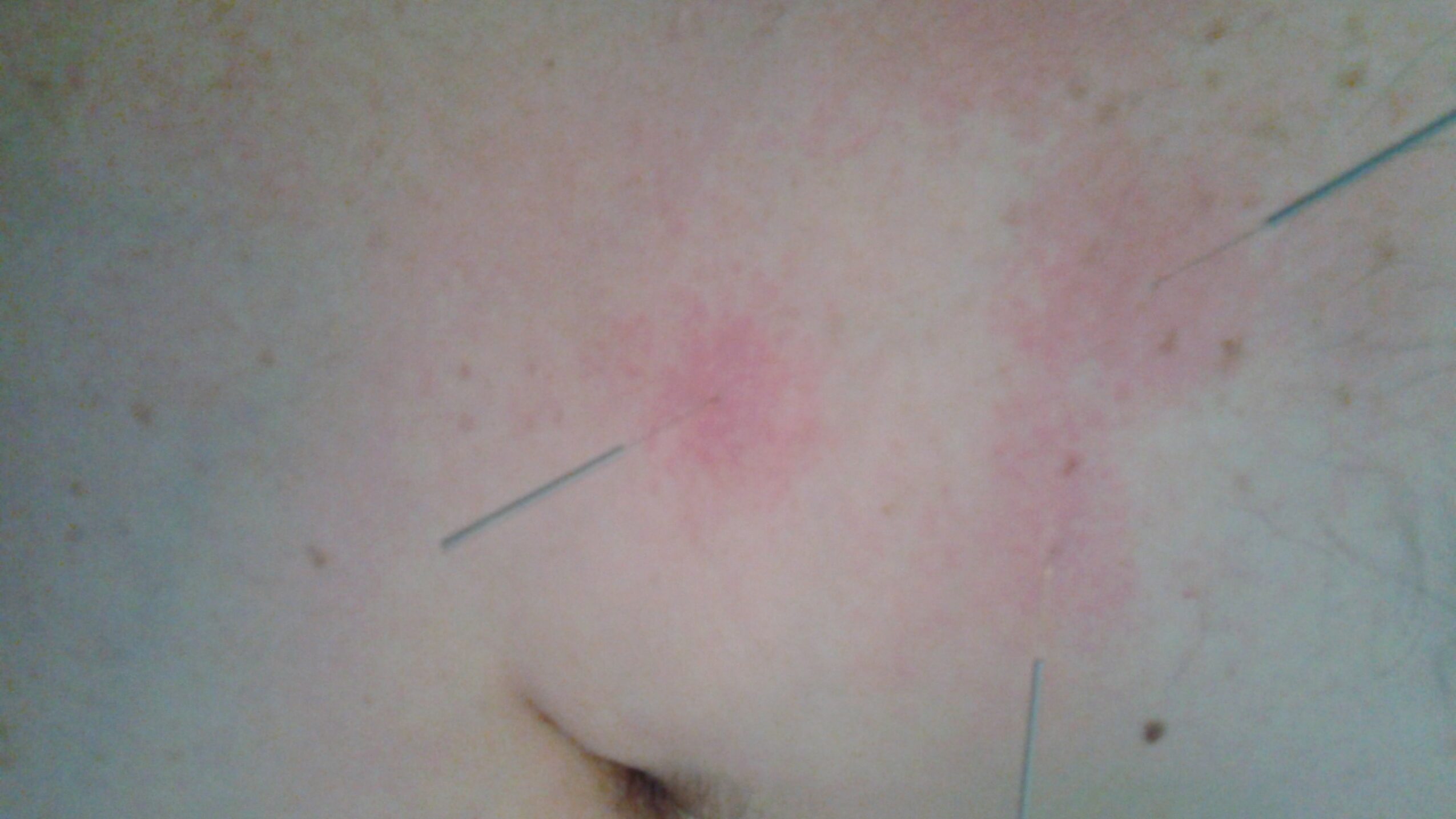 Close-up of skin with two red, irritated patches and a few hair follicles visible.