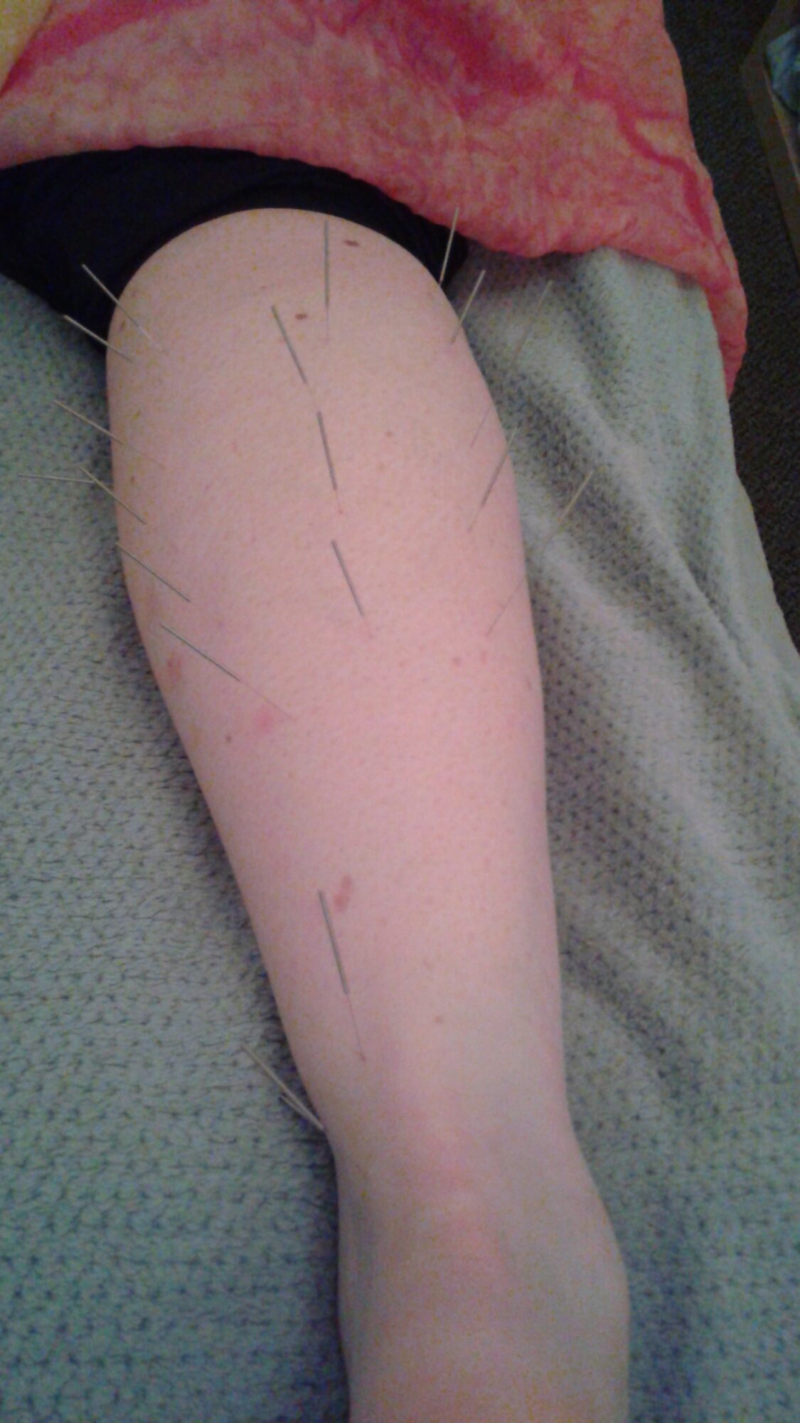 A person's arm with surgical markings lying on a medical surface.