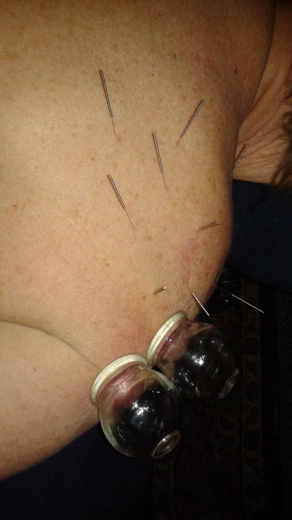 Back with multiple acupuncture needles inserted and two cupping therapy cups on the shoulder area.