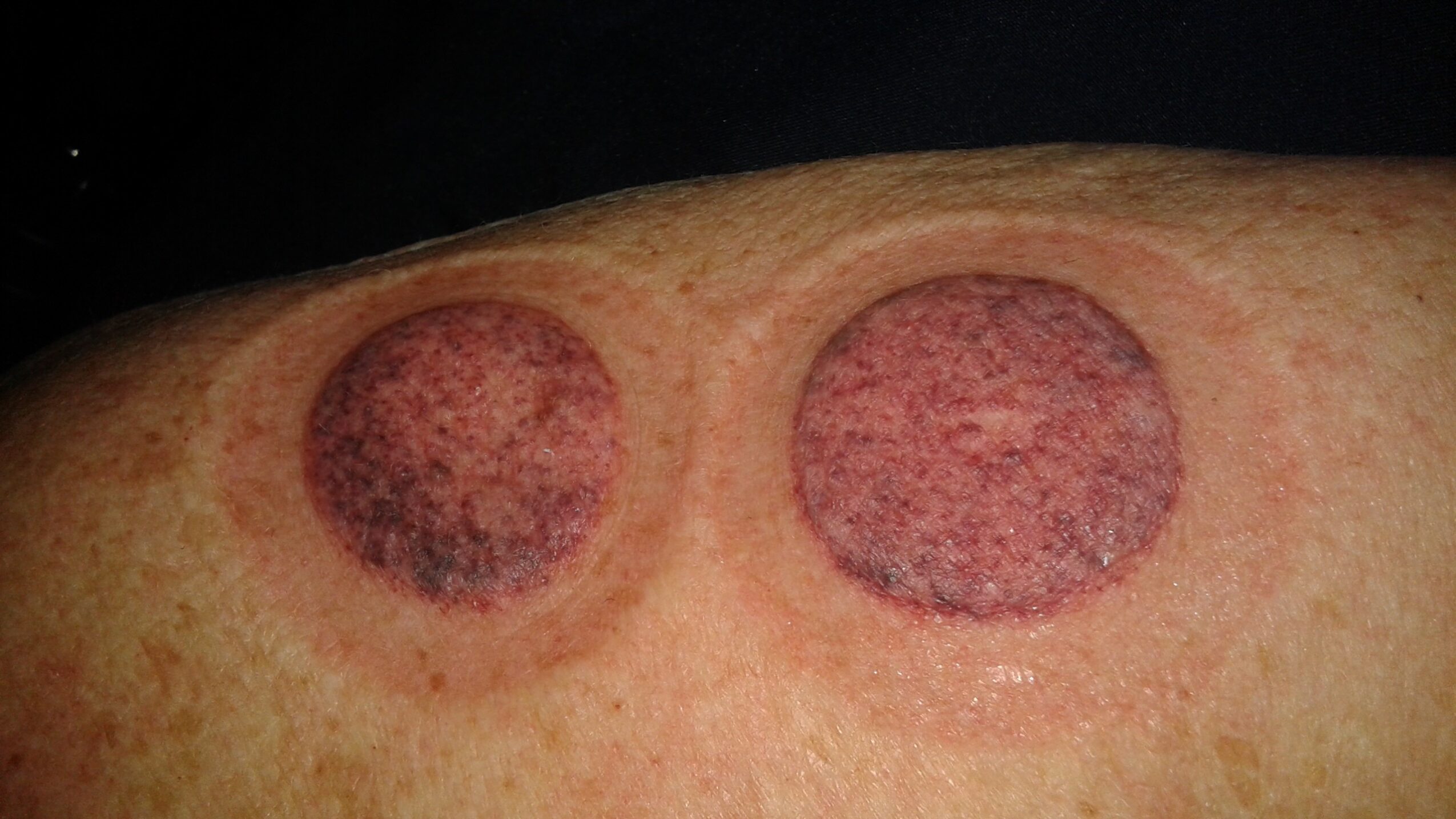 Two circular skin lesions with reddish and darkened areas on skin.